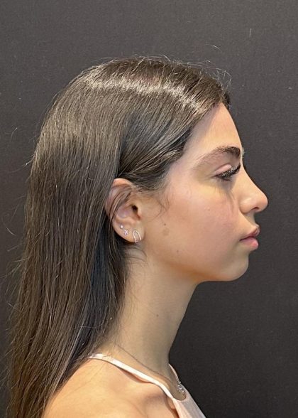 Rhinoplasty Before & After Patient #6699