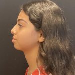 Rhinoplasty Before & After Patient #6699