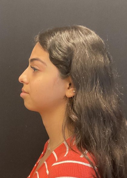 Rhinoplasty Before & After Patient #6699