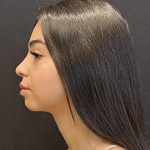 Rhinoplasty Before & After Patient #6699