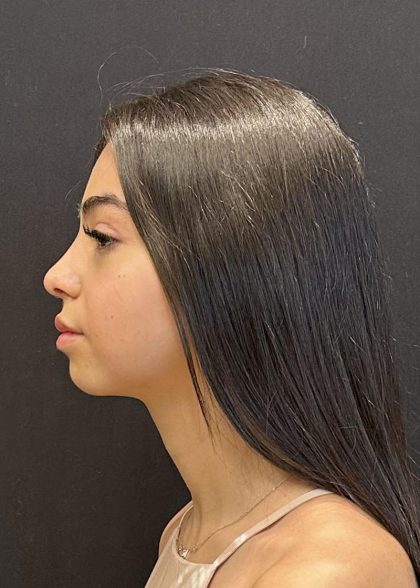 Rhinoplasty Before & After Patient #6699