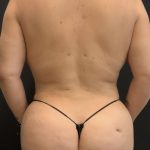 Rib Repositioning Before & After Patient #6483