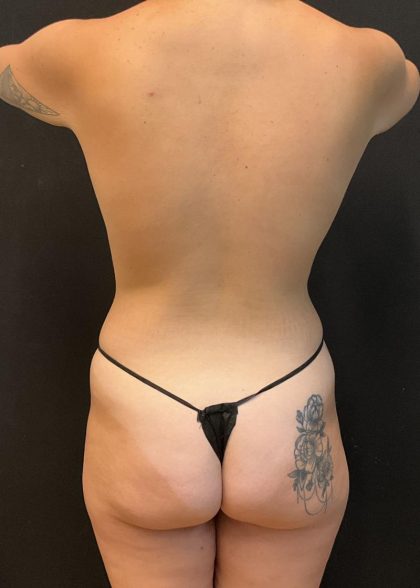 Rib Repositioning Before & After Patient #6485