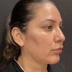 Submental Liposuction Before & After Patient #6342