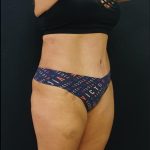 Tummy Tuck Before & After Patient #6310