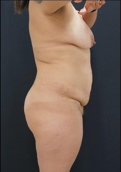Tummy Tuck Before & After Patient #6310