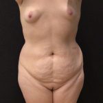 Tummy Tuck Before & After Patient #6312