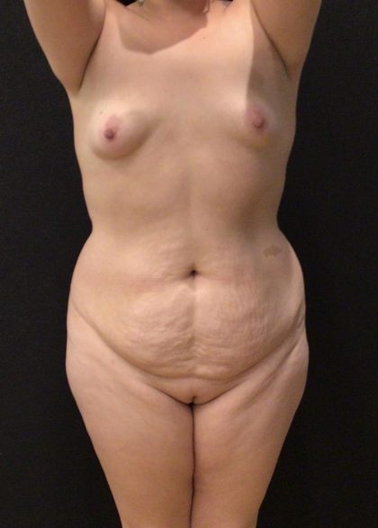 Tummy Tuck Before & After Patient #6312