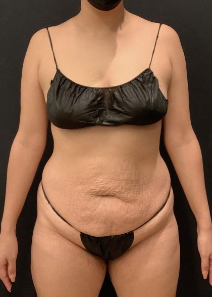 Tummy Tuck Before & After Patient #6313