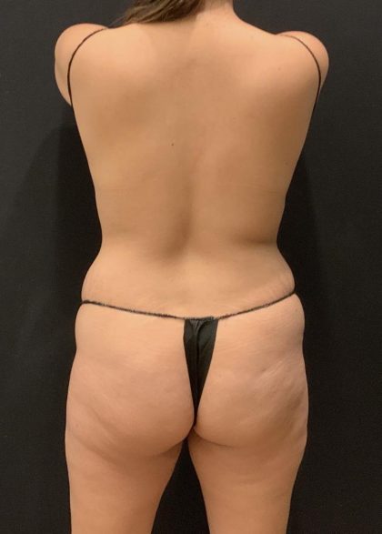 Tummy Tuck Before & After Patient #6313