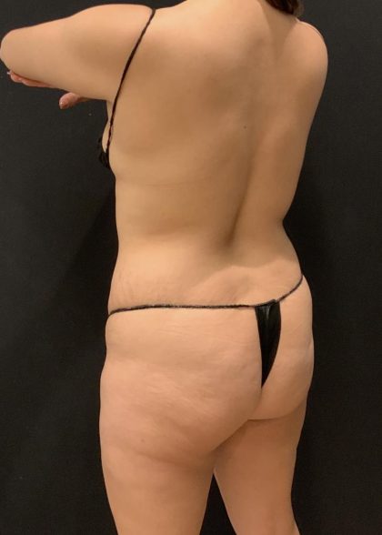 Tummy Tuck Before & After Patient #6313