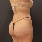 Tummy Tuck Before & After Patient #6313