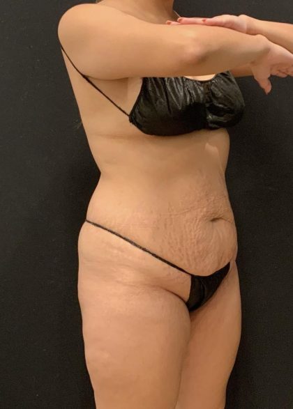 Tummy Tuck Before & After Patient #6313