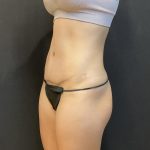 Tummy Tuck Before & After Patient #6315