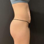 Tummy Tuck Before & After Patient #6315