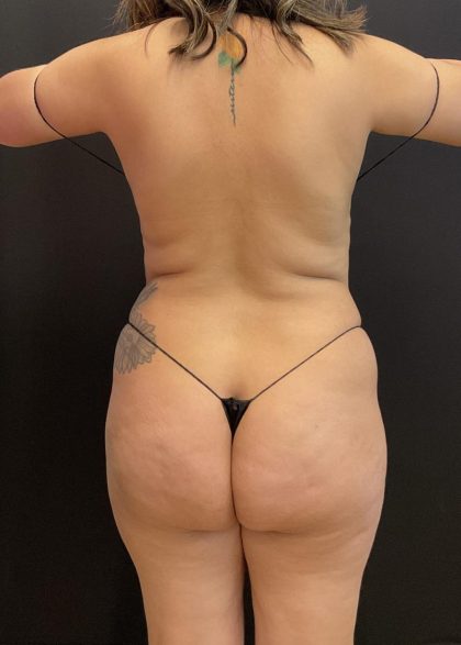 Tummy Tuck Before & After Patient #6326