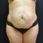 Tummy Tuck Before & After Patient #6303