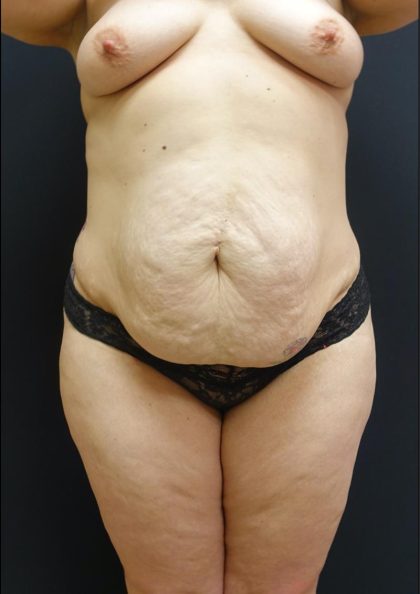 Tummy Tuck Before & After Patient #6303