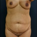Tummy Tuck Before & After Patient #6305