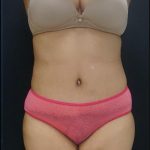 Tummy Tuck Before & After Patient #6305
