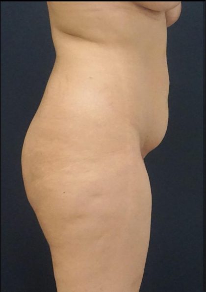 Tummy Tuck Before & After Patient #6307