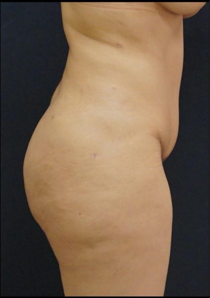 Tummy Tuck Before & After Patient #6307