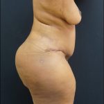 Tummy Tuck Before & After Patient #6308