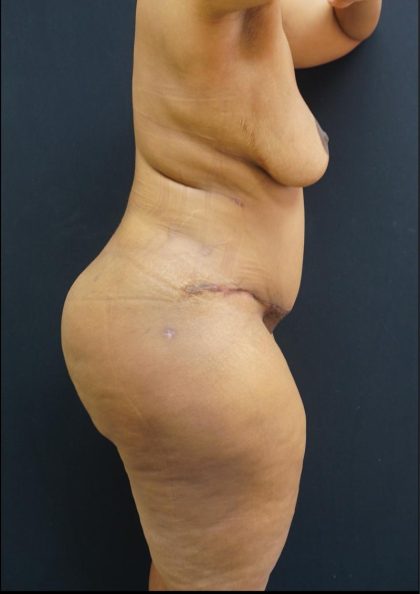 Tummy Tuck Before & After Patient #6308