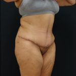 Tummy Tuck Before & After Patient #6309