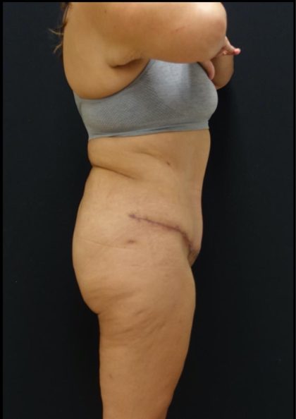 Tummy Tuck Before & After Patient #6309