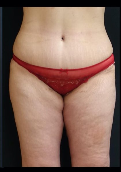 Thigh Lift Before & After Patient #6564