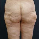 Thigh Lift Before & After Patient #6564