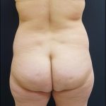 Thong Lift Before & After Patient #6547