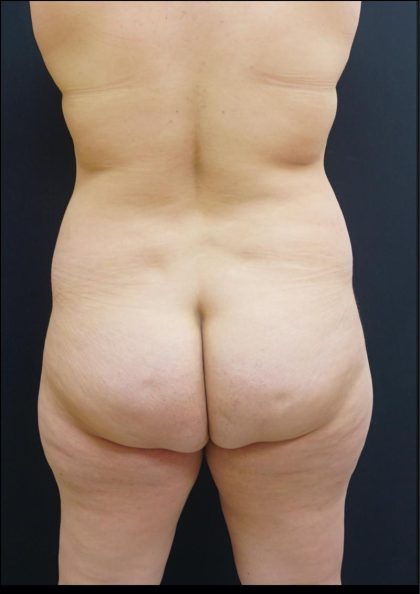 Thong Lift Before & After Patient #6547