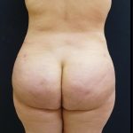 Thong Lift Before & After Patient #6547