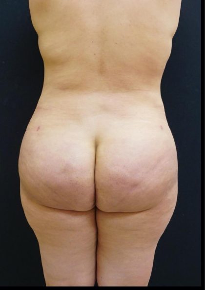 Thong Lift Before & After Patient #6547