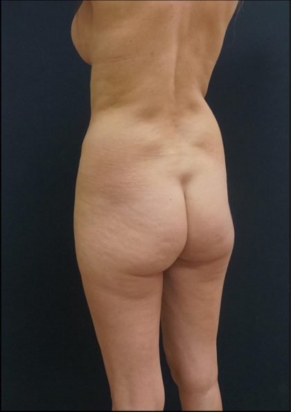 Thong Lift Before & After Patient #6548