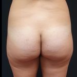 Thong Lift Before & After Patient #6549