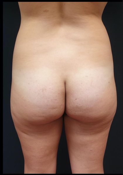 Thong Lift Before & After Patient #6549