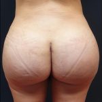 Thong Lift Before & After Patient #6549