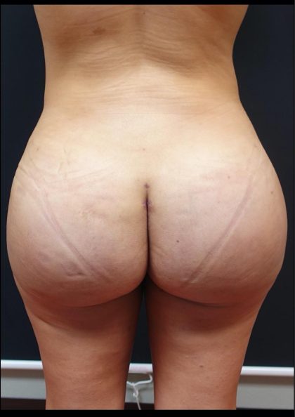 Thong Lift Before & After Patient #6549