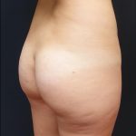 Thong Lift Before & After Patient #6549