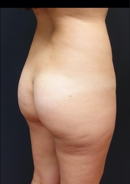 Thong Lift Before & After Patient #6549