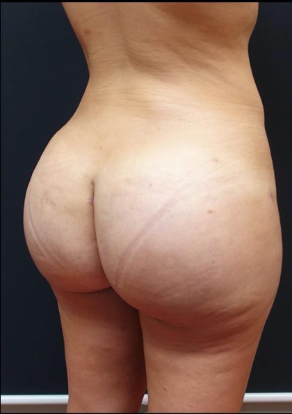 Thong Lift Before & After Patient #6549