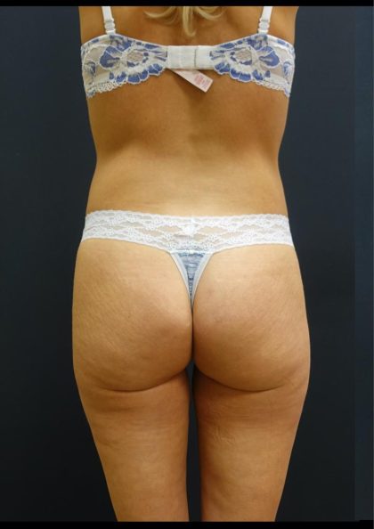 Thong Lift Before & After Patient #6551