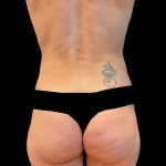 Rib Repositioning Before & After Patient #6484