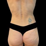 Rib Repositioning Before & After Patient #6484