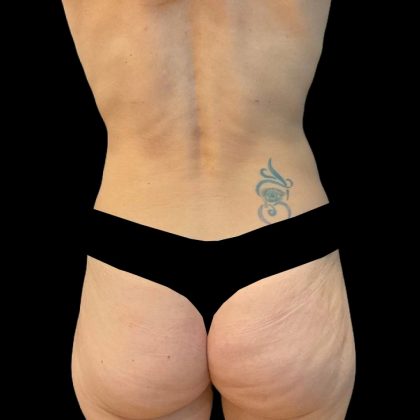 Rib Repositioning Before & After Patient #6484