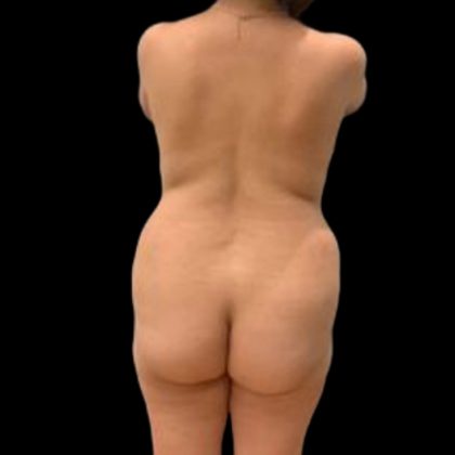 Tummy Tuck Before & After Patient #5074