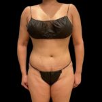 Tummy Tuck Before & After Patient #5074